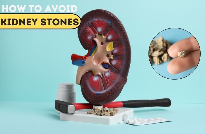 How to Avoid Kidney Stones