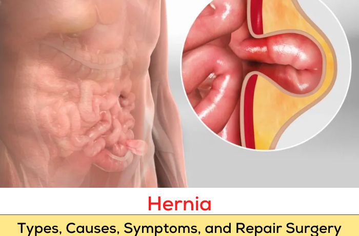 Hernia: Types, Causes, Symptoms, and Repair Surgery