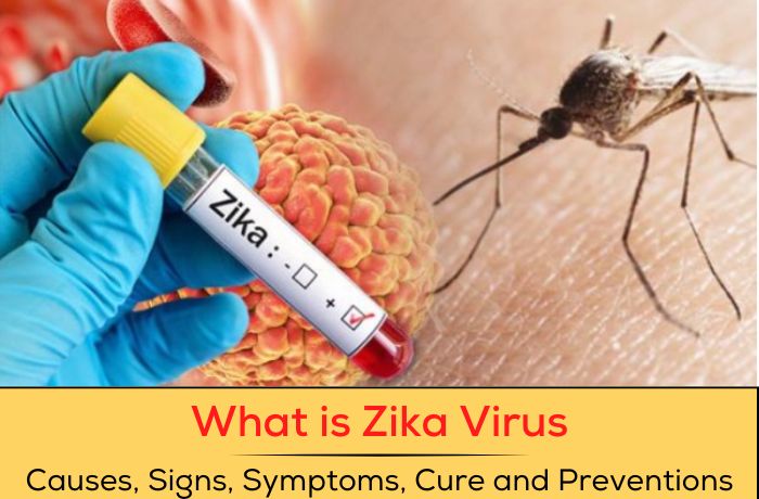 .What is Zika Virus: Causes, Signs, Symptoms, Cure and Preventions