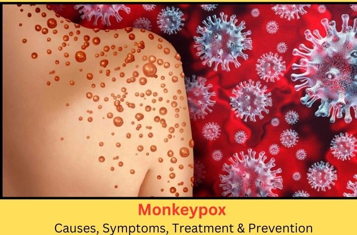 Monkeypox: Causes, Symptoms, Treatment & Prevention