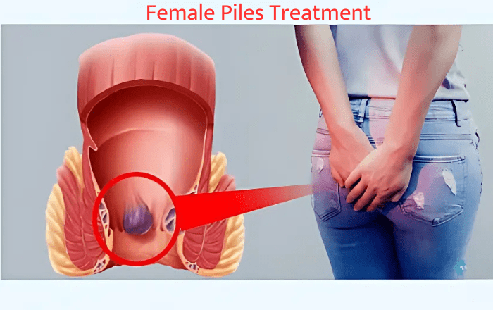 female piles treatment Best Female Piles Specialist in Undri | Dr. Shweta Poman-Jain
